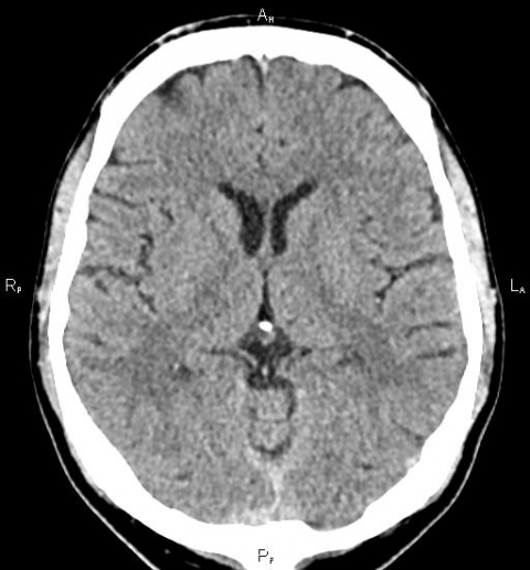 CT mozku
