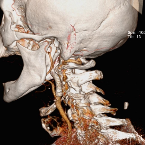 CTA karotidy VRT - stent