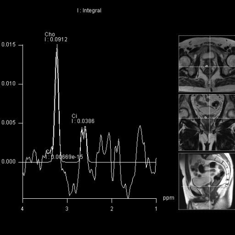 MR prostaty - spektroskopie