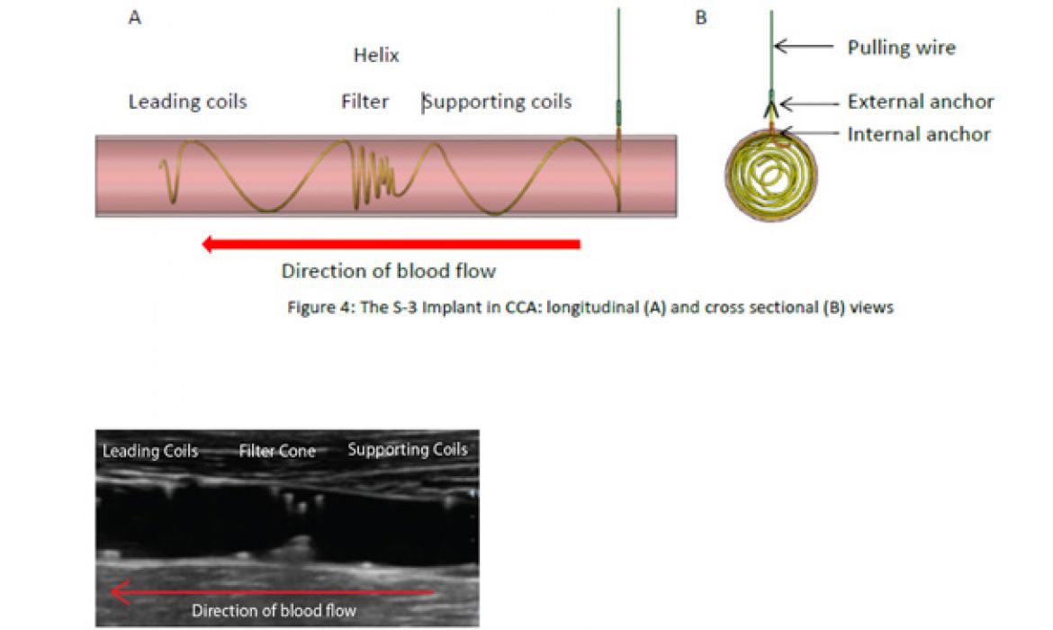 Homolka Miktrofiltr - fibrilace srdečních síní