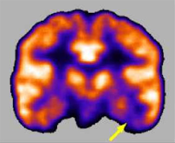 PET mozku s FDG