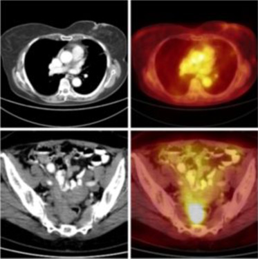 PET/CT trupu s FDG a i.v. p.o. kontrastem