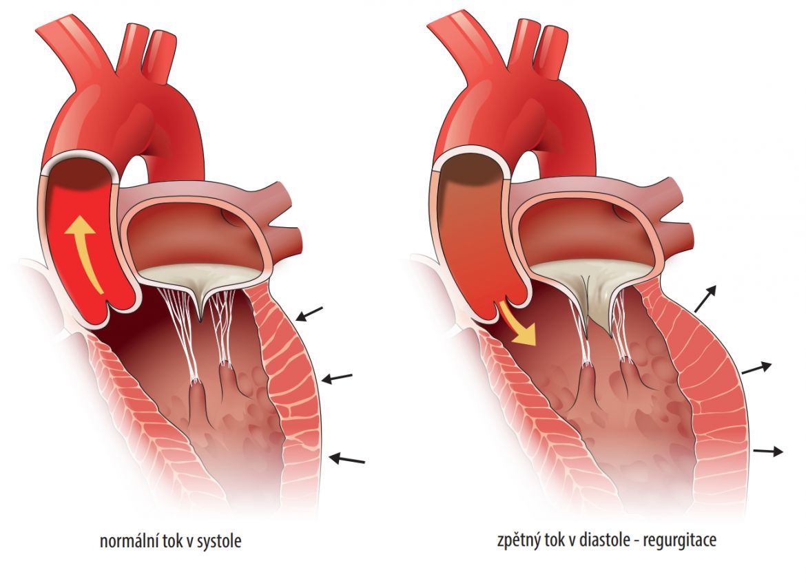 Aortální regurgitace
