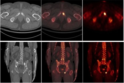 PET/CT skeletu s NaF