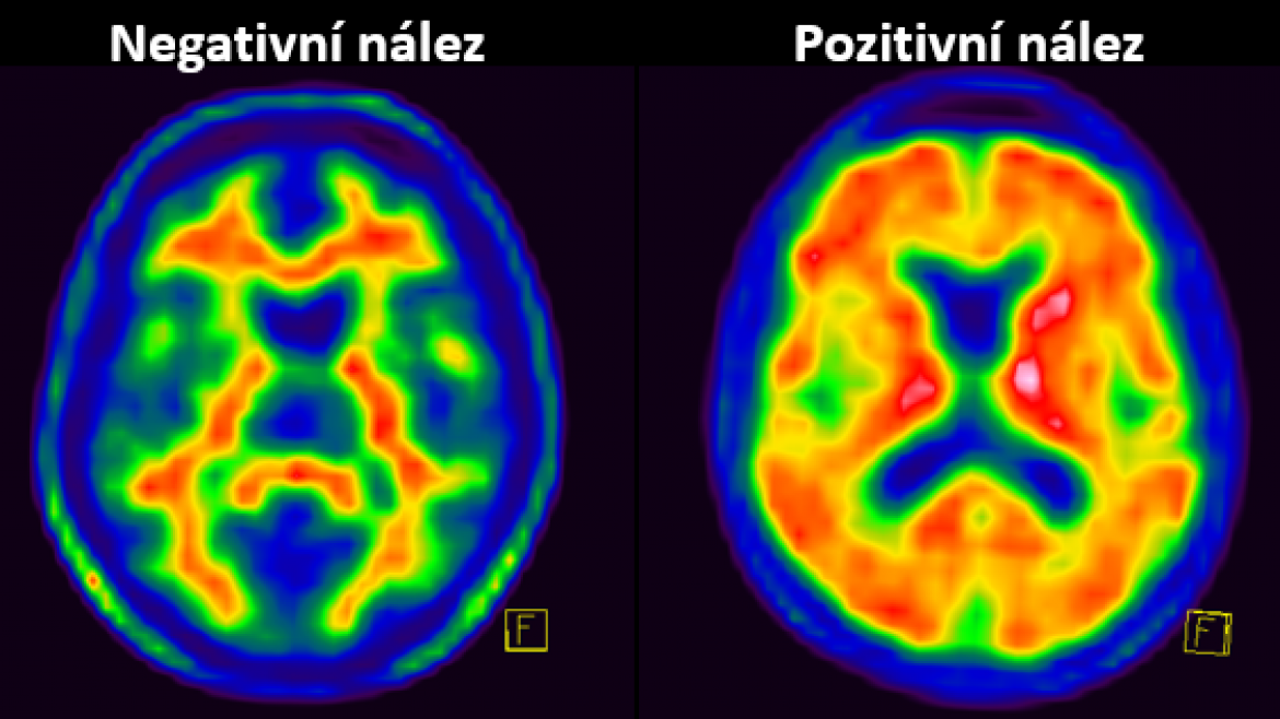 beta-amyloid