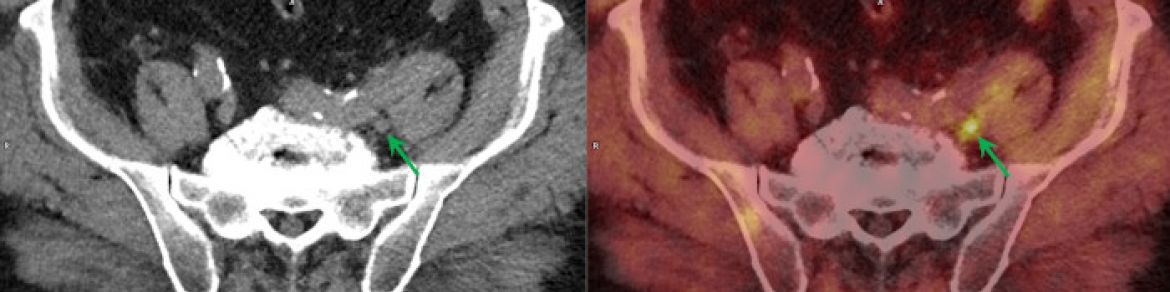 FCV-PET/CT