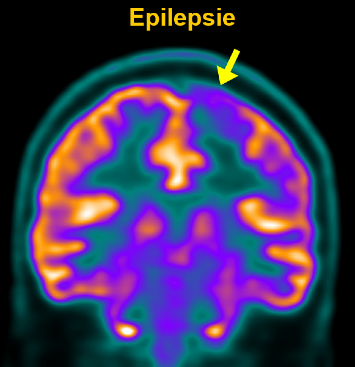 epilepsie