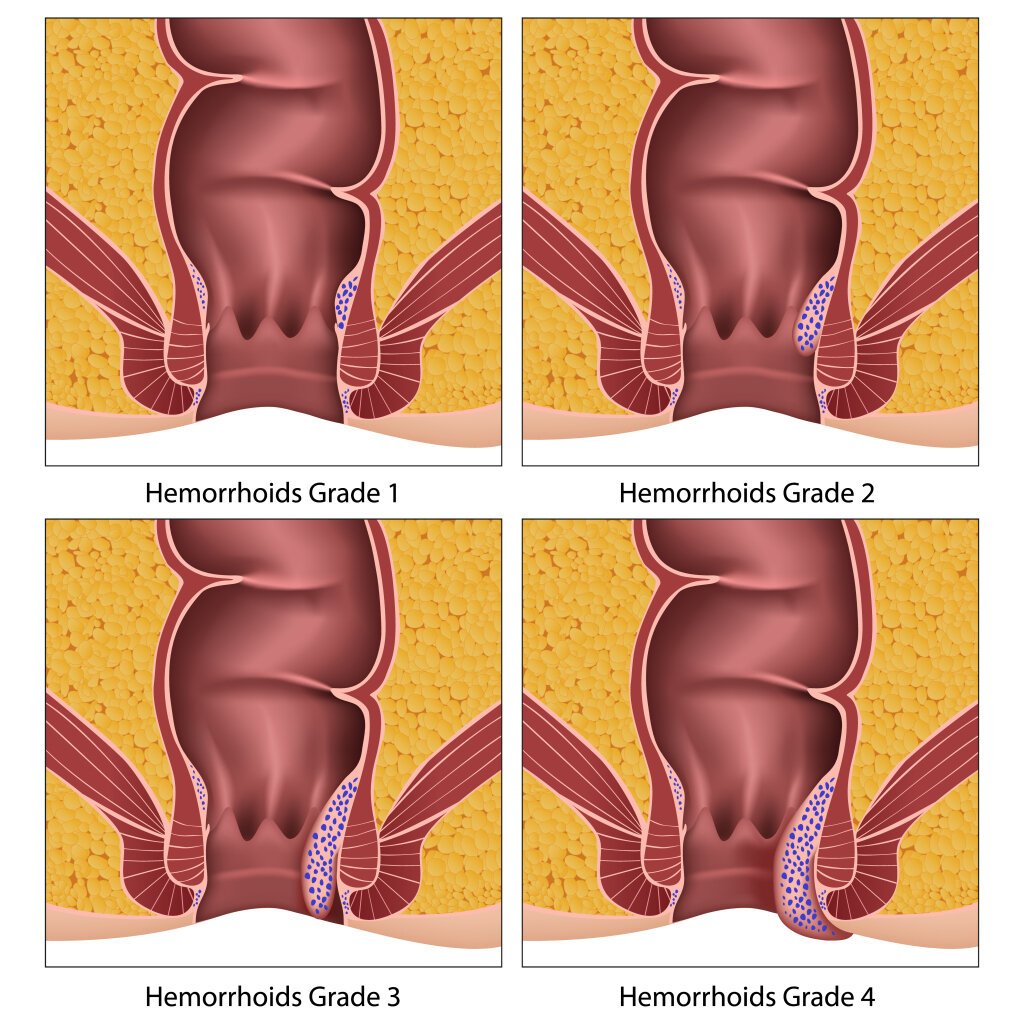 Hemoroidy vnitřní - stádia